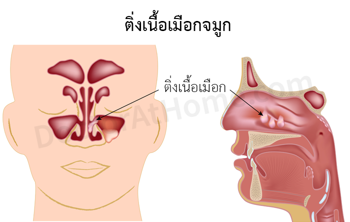 ติ่งเนื้อเมือกจมูก